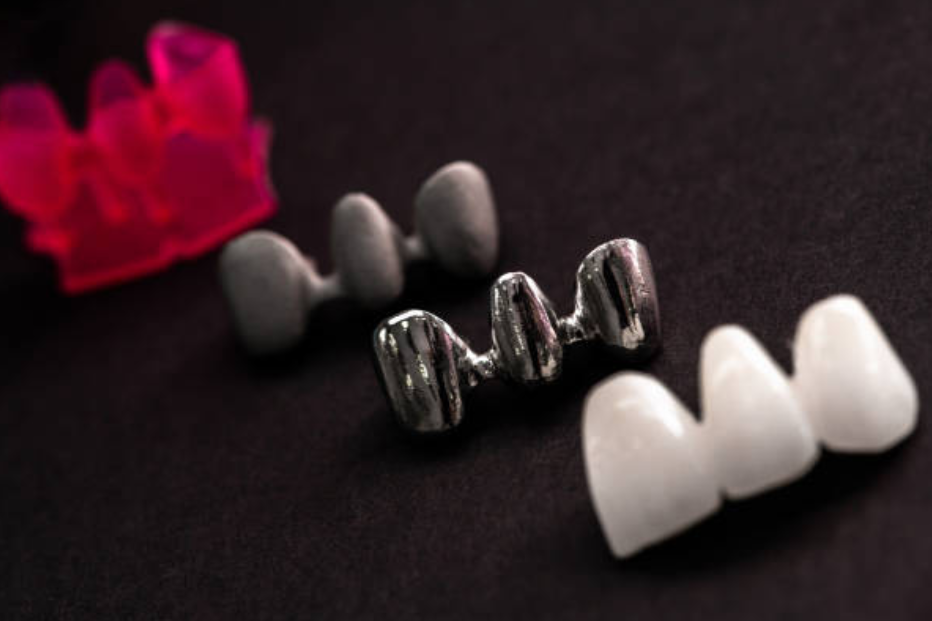 mim-dental-implants