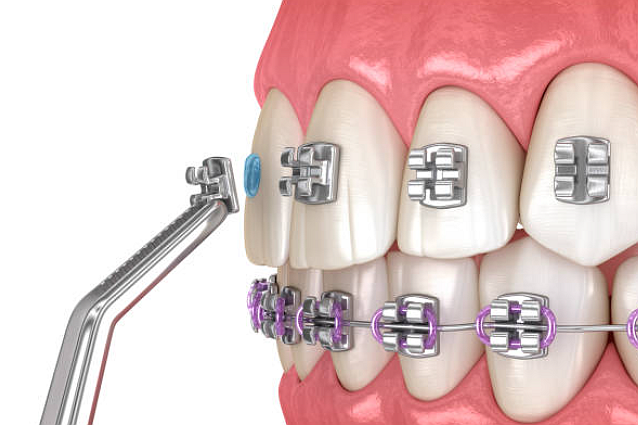 injection-molded-dental-prosthetics